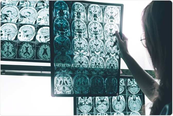 MRI of Alzheimer's. Image Credit: Atthapon Raksthaput / Shutterstock